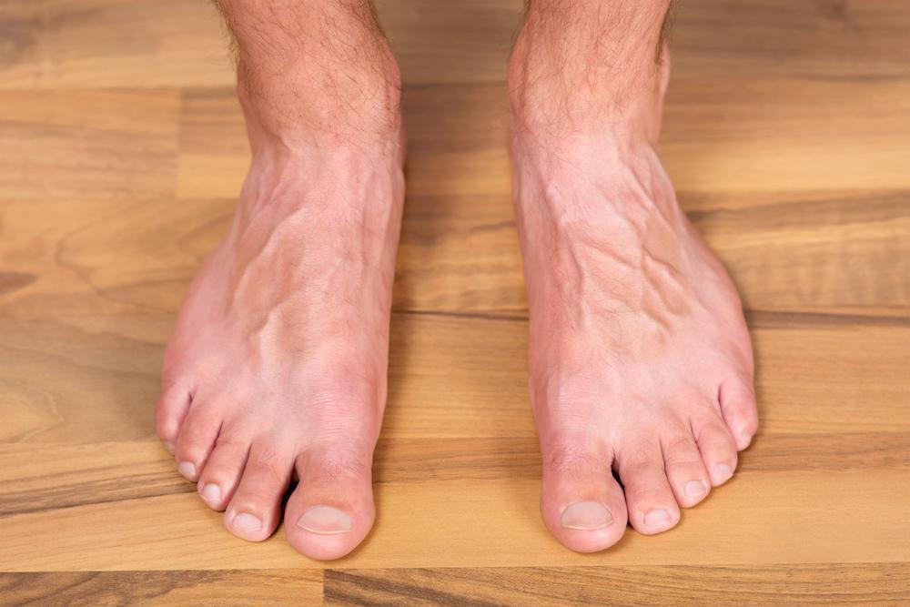 What is Adult-Acquired Flatfoot and is it Serious?