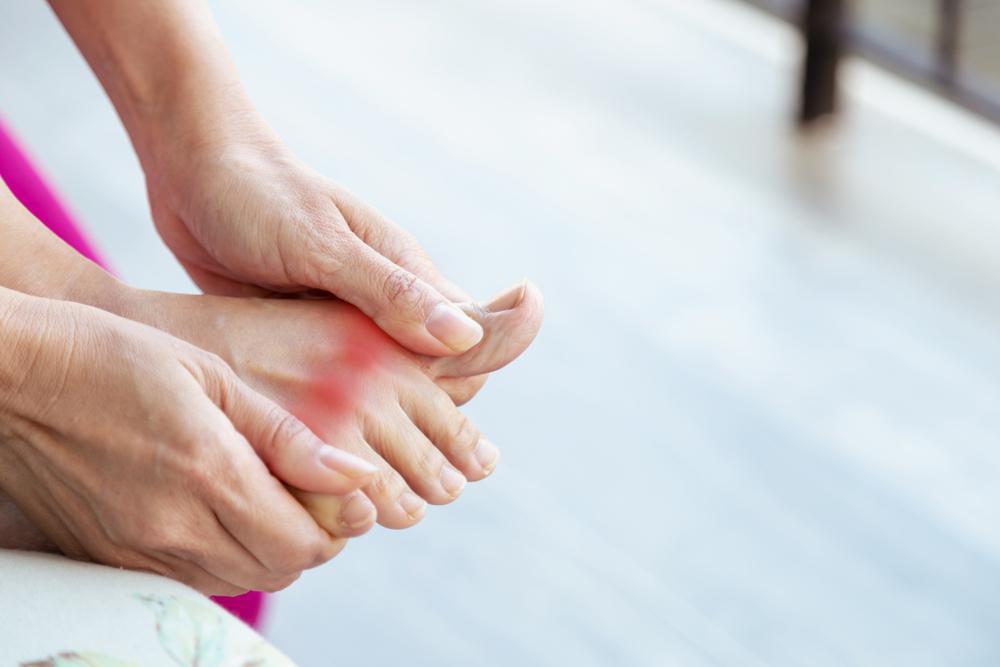 Steps to Take During a Gout Flare-Up