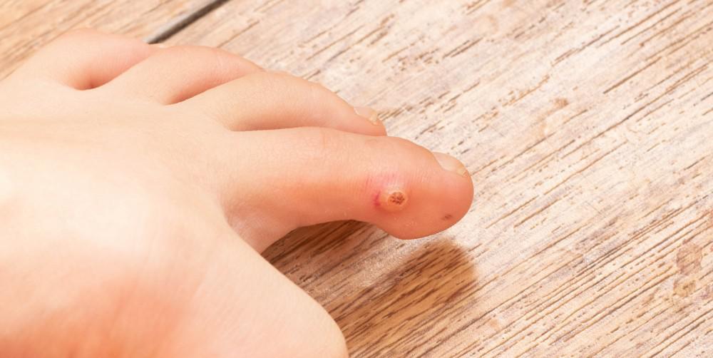 Corns and Calluses: What’s the Difference and When Do They Require Care?