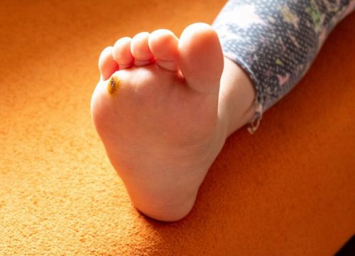 Plantar wart on a child's foot
