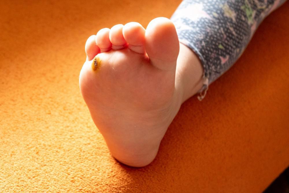 The Risk of Plantar Warts for Children and Teenagers