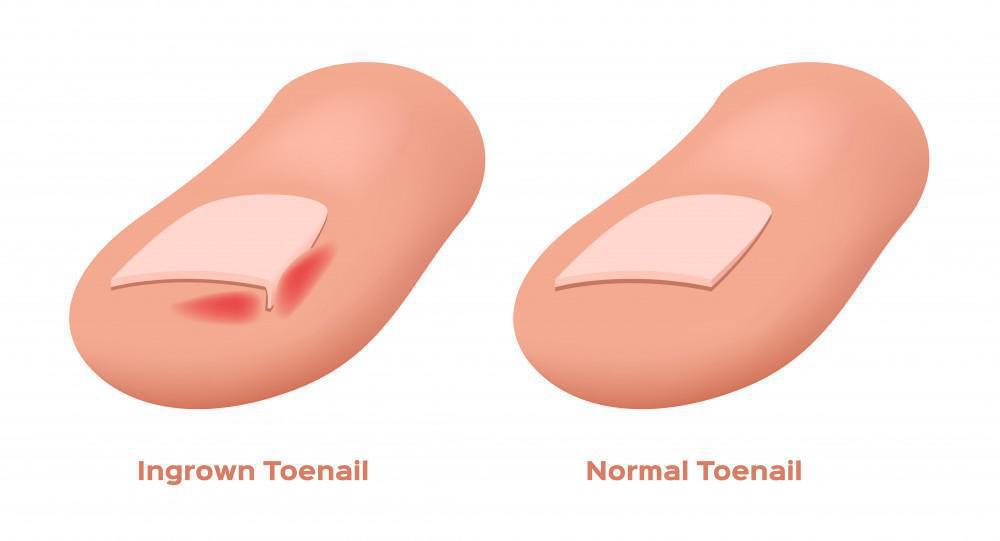 What Happens If My Toenail Gets Infected