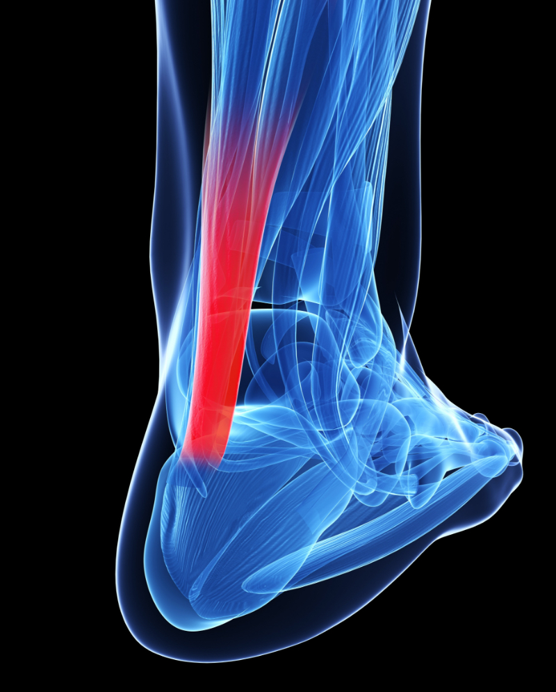 X-ray view of the achilles tendon