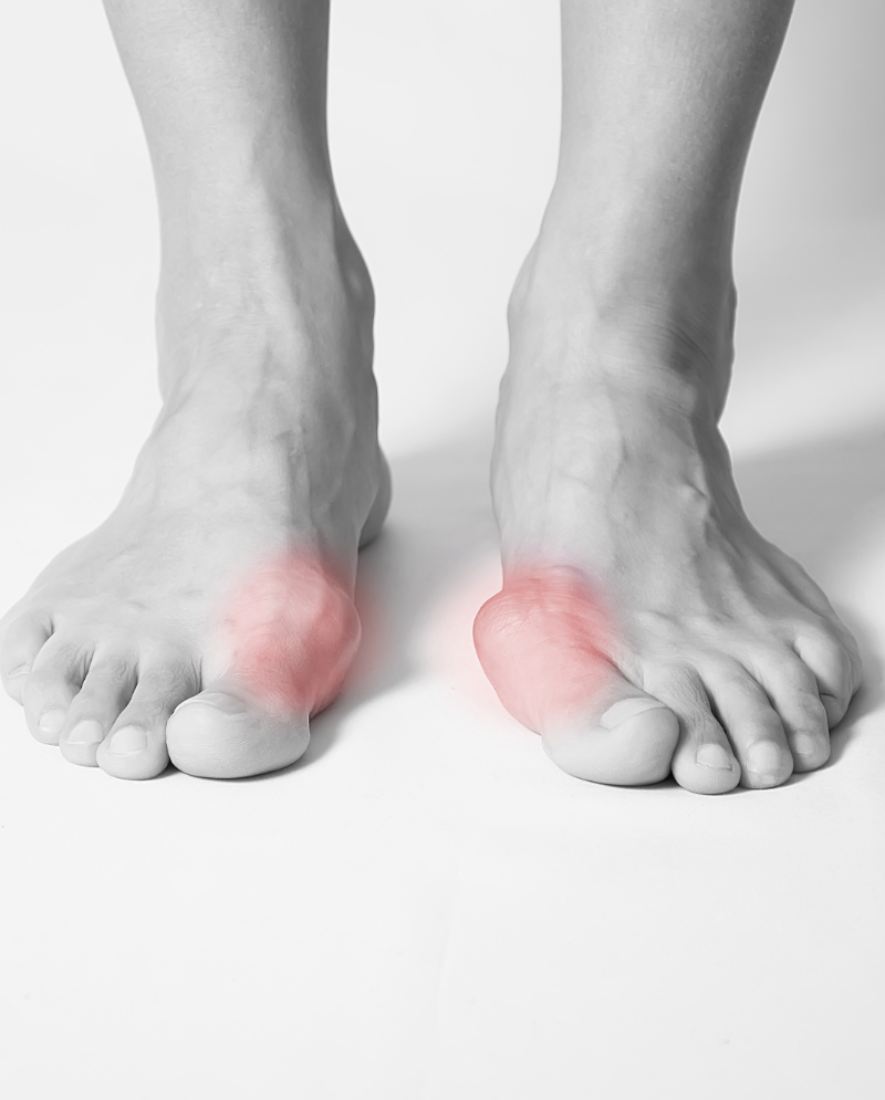 Big Toe Joint Pain — Fairfield Podiatry