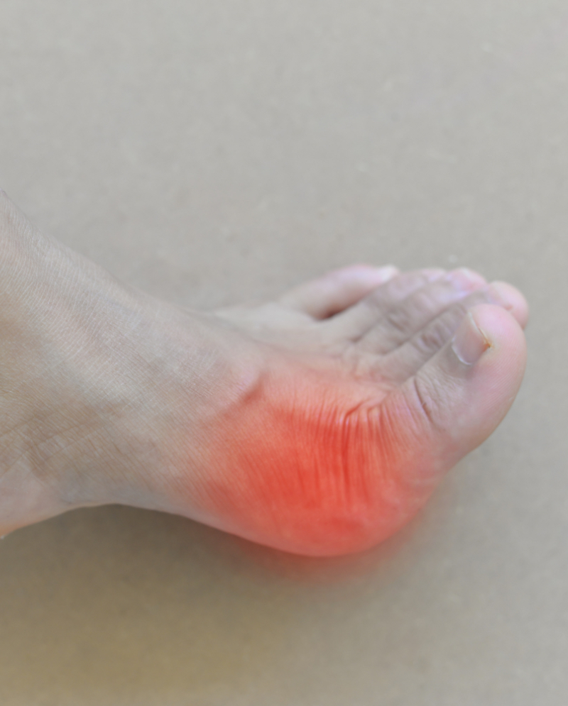 Area of gout pain, highlighted