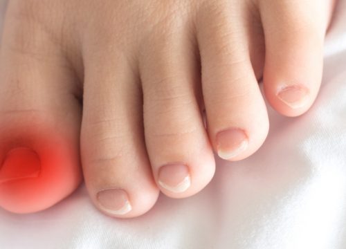 Ingrown toenail pain area on a foot