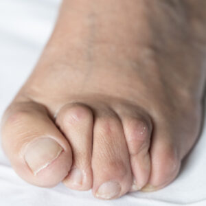While Not Life Threatening, Hammertoe Can Be Quite Painful