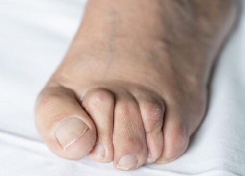 How Cortisone Shots Can Help Relieve Pain in the Legs and Feet | Beyond Podiatry