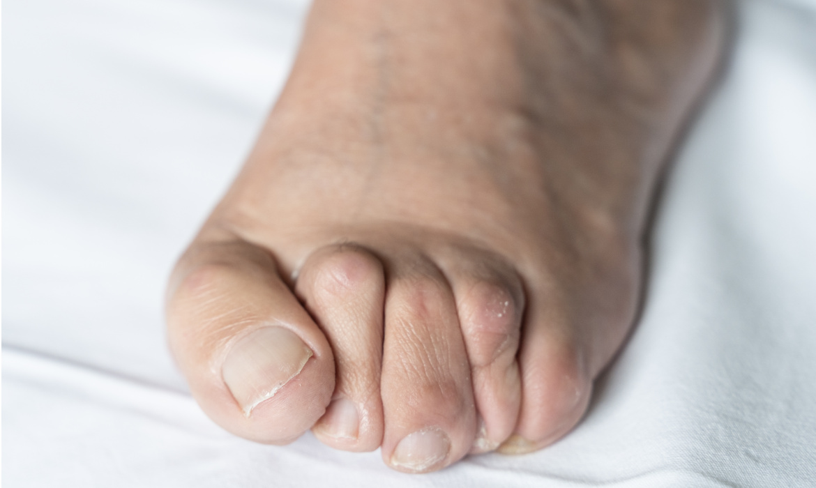 While Not Life Threatening, Hammertoe Can Be Quite Painful